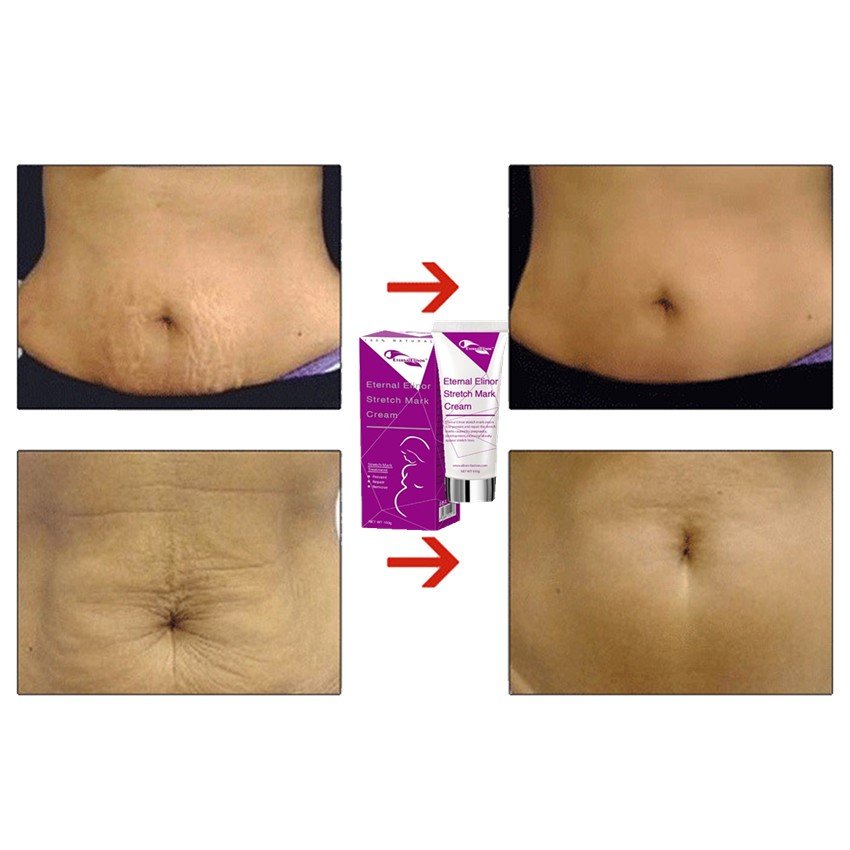 High Quality Powerful Stretch Marks Remover Skin Repair Cream Treatment Scar Removal Pregnancy Cream