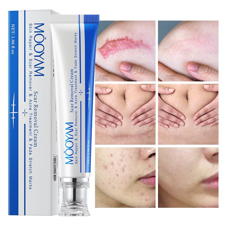 Strong Effective Acne Scar Removal Cream Pimples Stretch Marks Remove Face Gel Tummy Tuck Tightening Stretch Mark Removal Cream