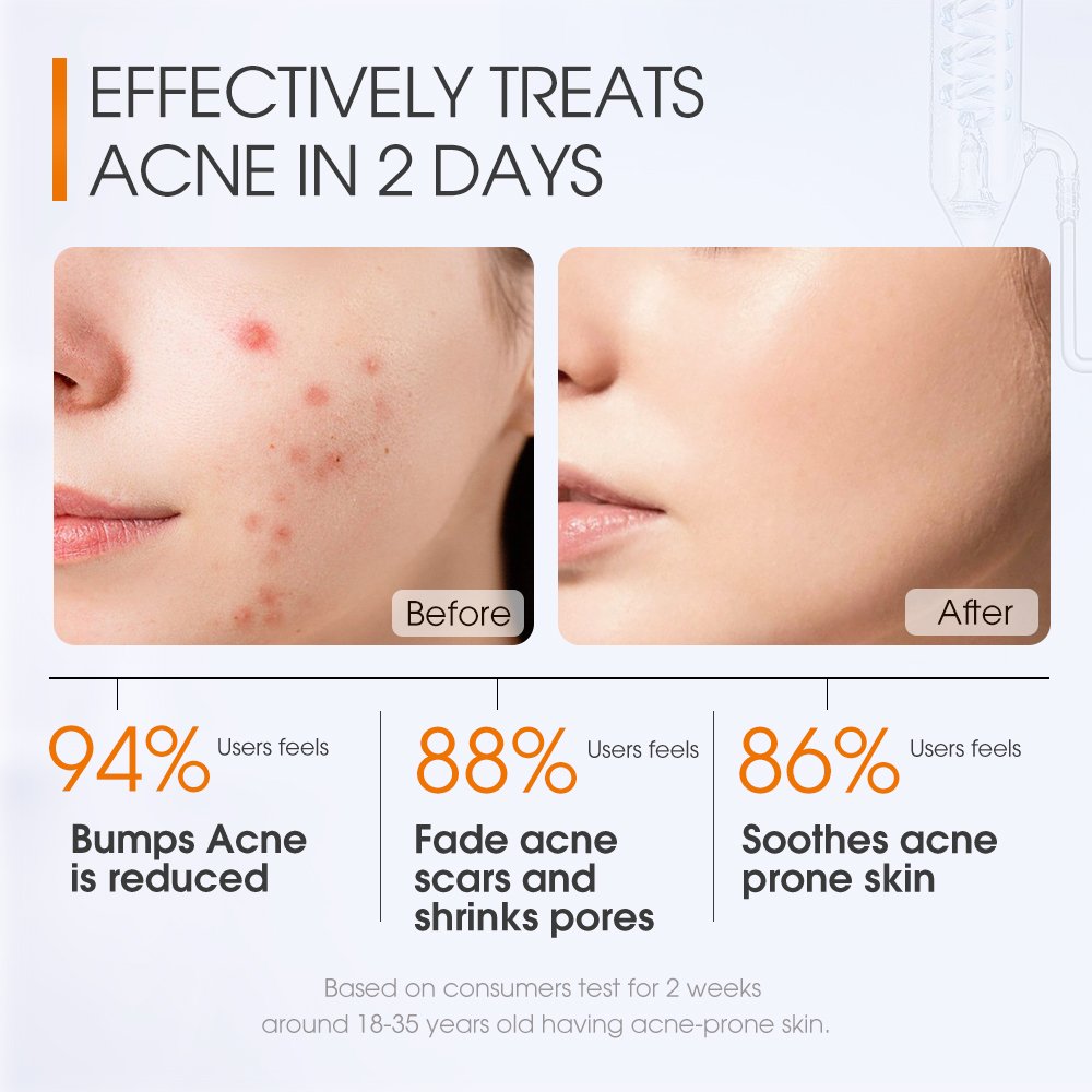 SKINEVER Fast Acting Anti-Acne Serum Salicylic Acid Liquid Face Serum Acne Reduction Anti-Wrinkle Scar Elimination Herbal
