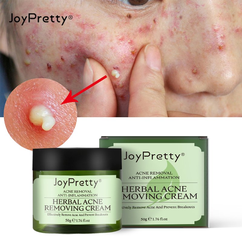 Private Label Organic Skin Care Repair Scar Acne Removal Cream Anti Acne Remover Pimple Treatment Face Cream