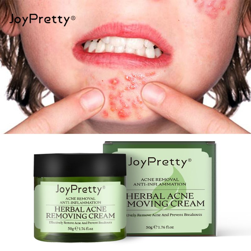 Private Label Organic Skin Care Repair Scar Acne Removal Cream Anti Acne Remover Pimple Treatment Face Cream