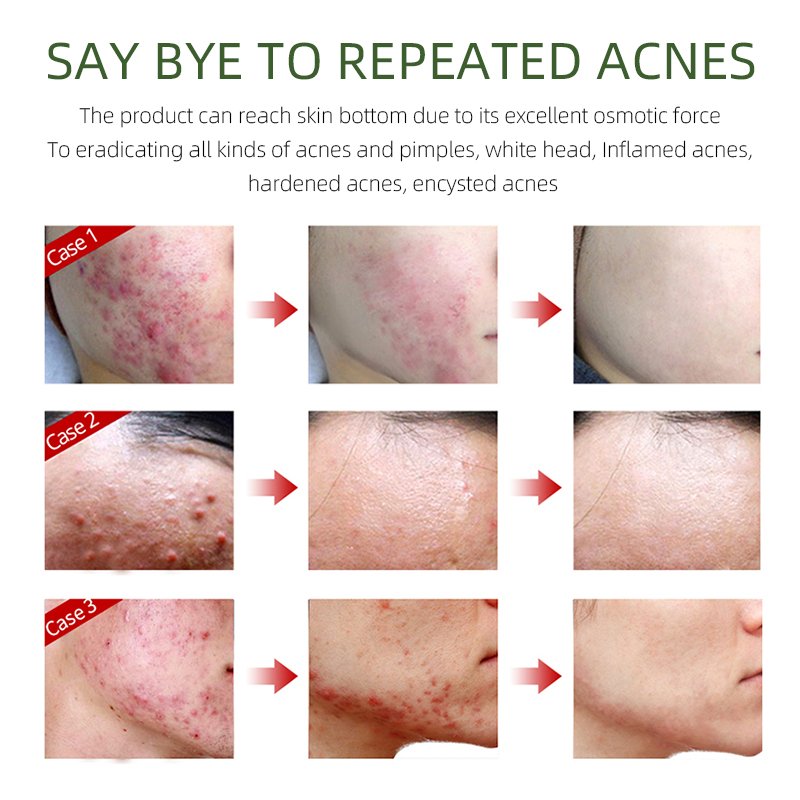 Private Label Organic Skin Care Repair Scar Acne Removal Cream Anti Acne Remover Pimple Treatment Face Cream