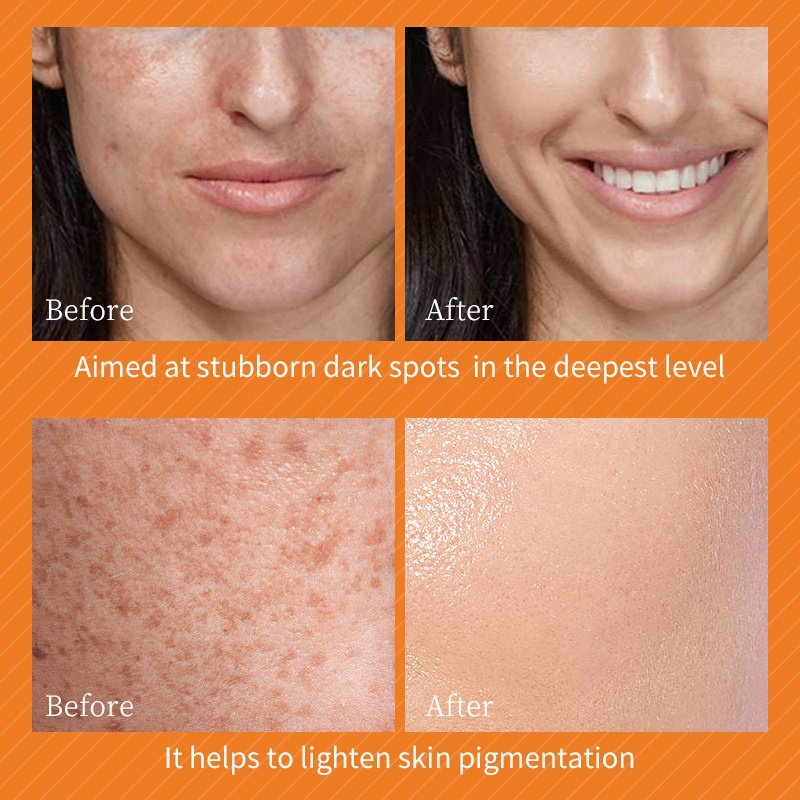 Quick skin bleaching lotion dark spot corrector remover whitening face cream for glowing skin