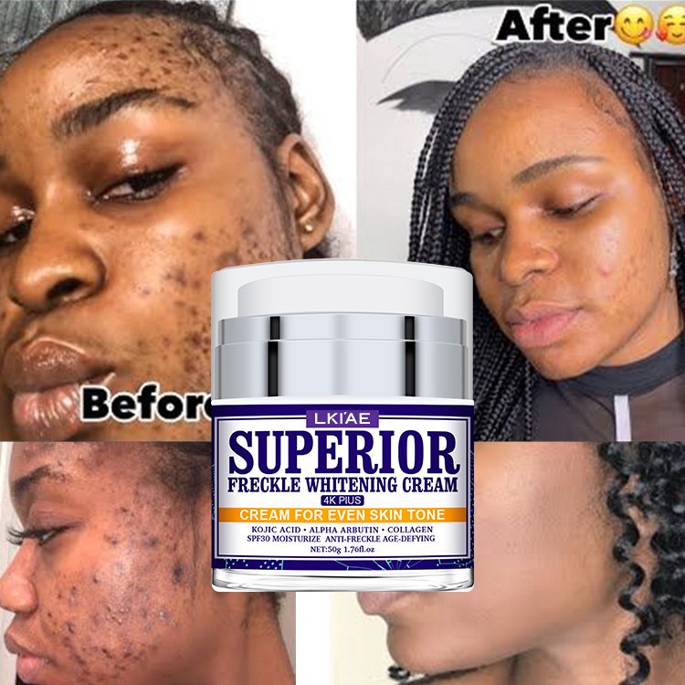 Private Label Skin Powerful Whitening Freckle Removal Face Bleaching Cream