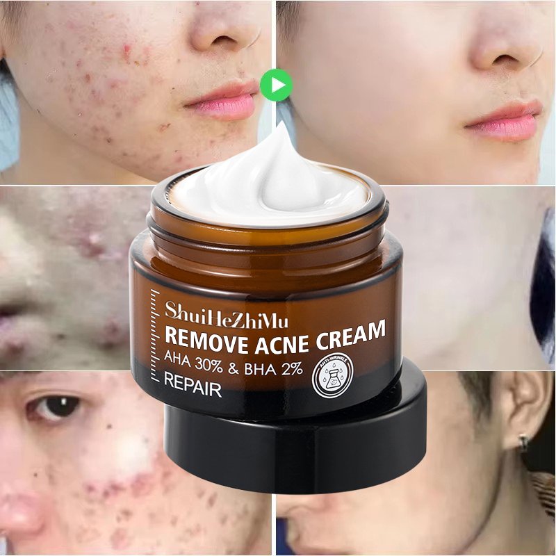 Organic Gel Anti Acne Scar Removal Face Cream With AHA BHA Herbal Smooth Remove Pimple Spot Treatment Cream
