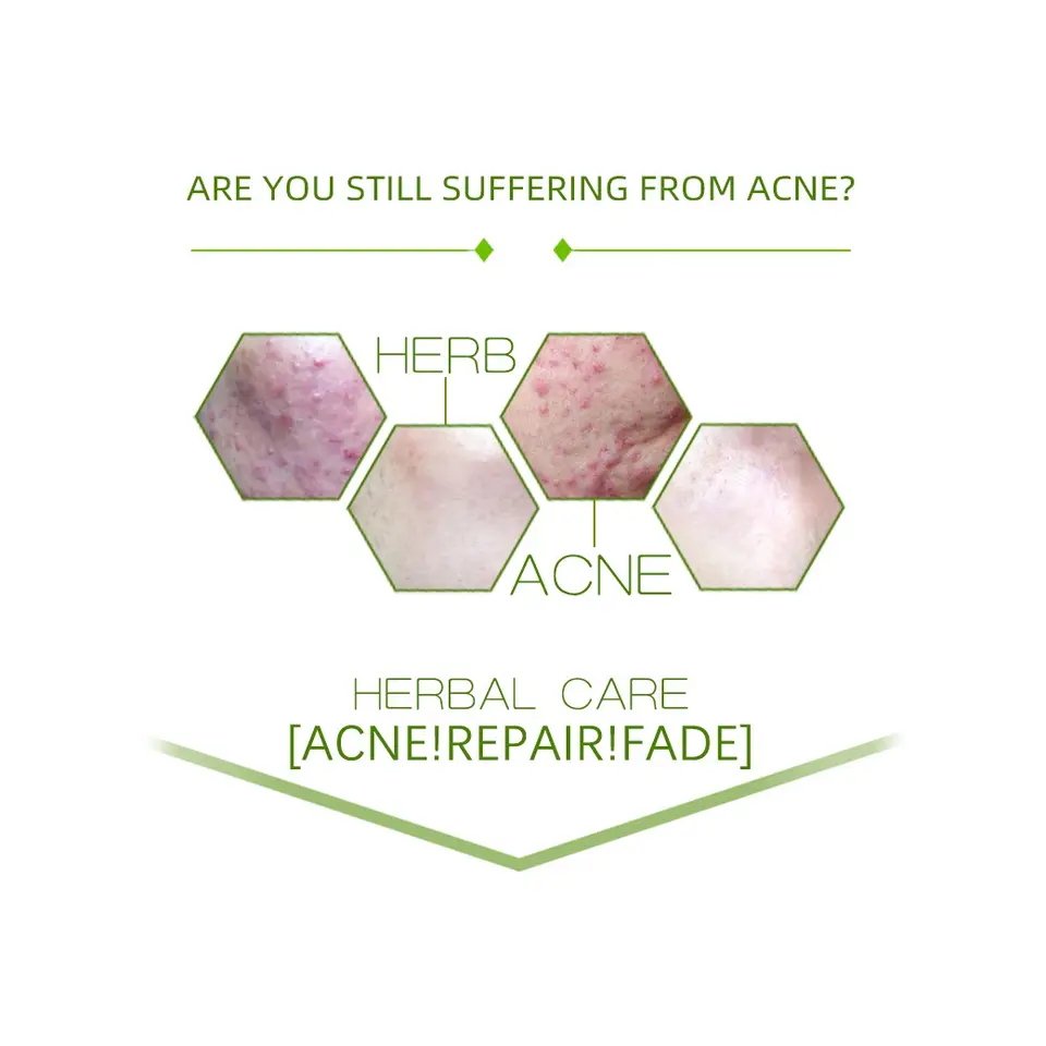 Organic Gel Anti Acne Scar Removal Face Cream With AHA BHA Herbal Smooth Remove Pimple Spot Treatment Cream