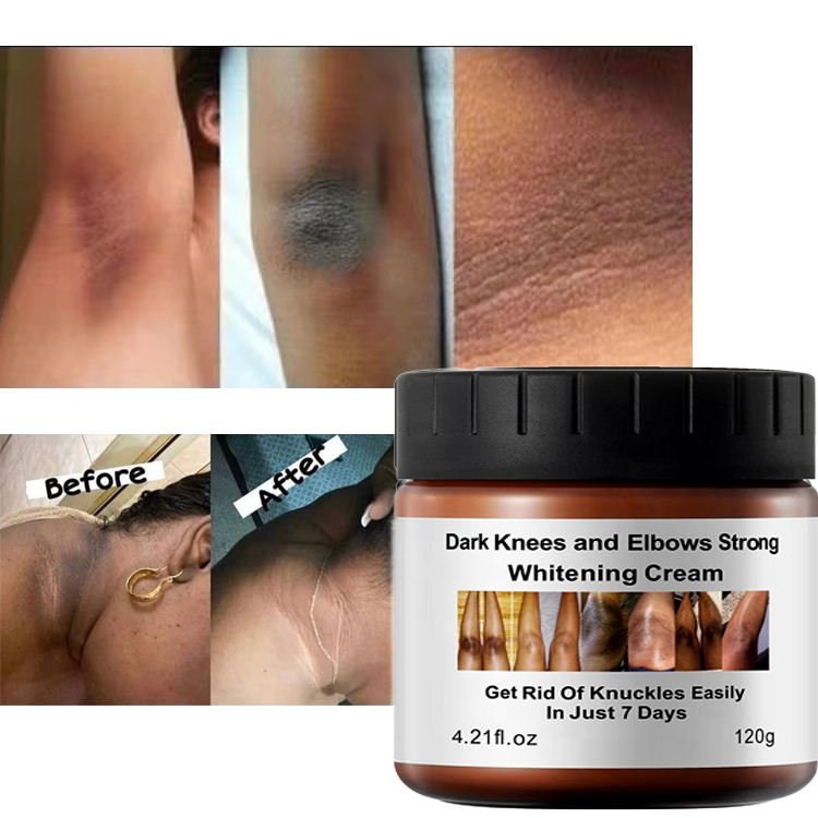 Private Label Best Strong Instant Whitening Cream for Dark Knees Knuckles and Elbows Fast Action Extreme Whitening Cream