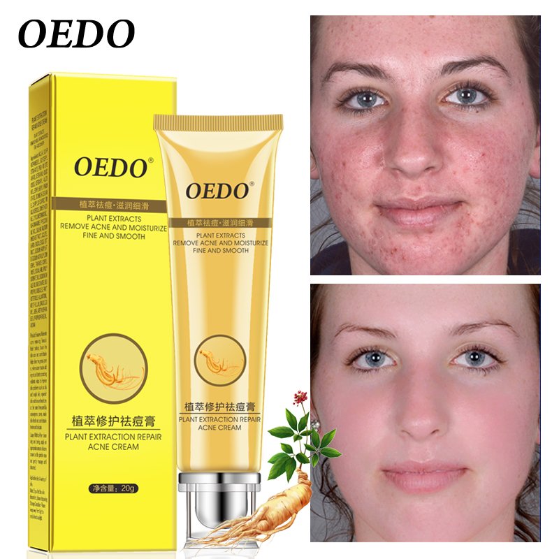 Plant Extraction Repair Anti Acne Face Cream Ginseng Scutellariae Extract Face Care Acne Scar Treatment Face Cream Whitening 20g
