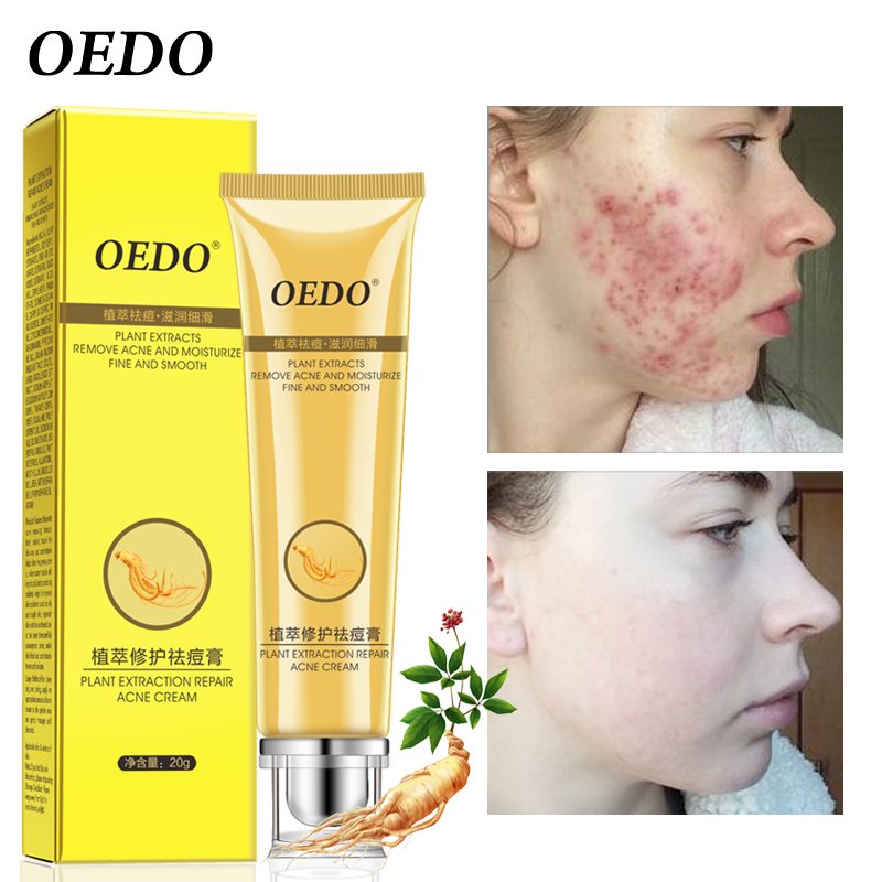 Plant Extraction Repair Anti Acne Face Cream Ginseng Scutellariae Extract Face Care Acne Scar Treatment Face Cream Whitening 20g