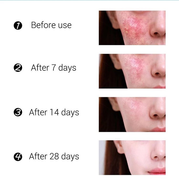 Private Label ODM OEM Beauty Whitening Body Cream Anti Acne Removal Face Cream moisturizer Vitamin C Acne Cream For Face
