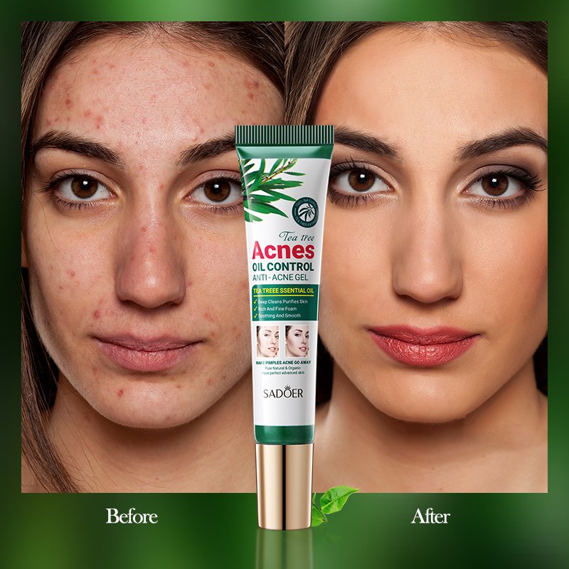 Acnes Gel Anti Acne Pimple Clear Remover Treatment Cream Moisturizer Beauty Face Korea Organic Natural Day Adults Female 2000