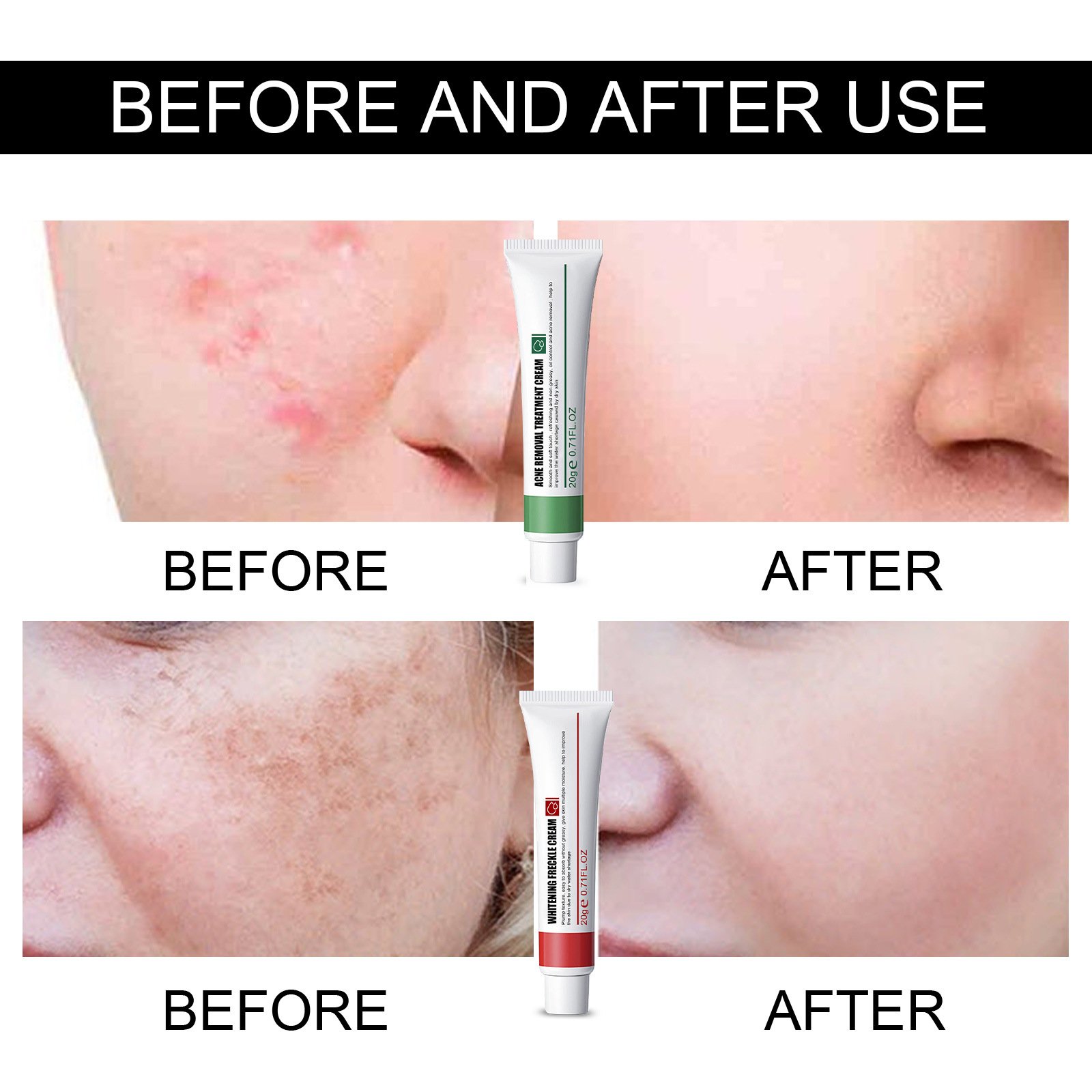 freckle remove anti aging facial lotion melasma dark spot removing corrector whitening face cream
