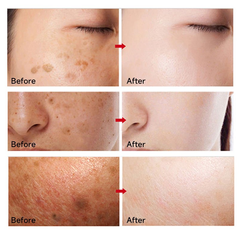 OEM ODM Whitening Anti-freckle Cream Lighten Reduce Spots Removing Pigmentation and Melanin Fade Melanin Face Cream