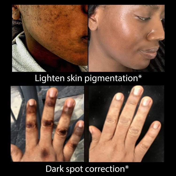 ailke Top Best Dark Skinned Bleaching Dark Spot Remover Skincare Natural Products Face And Body Whitening Cream