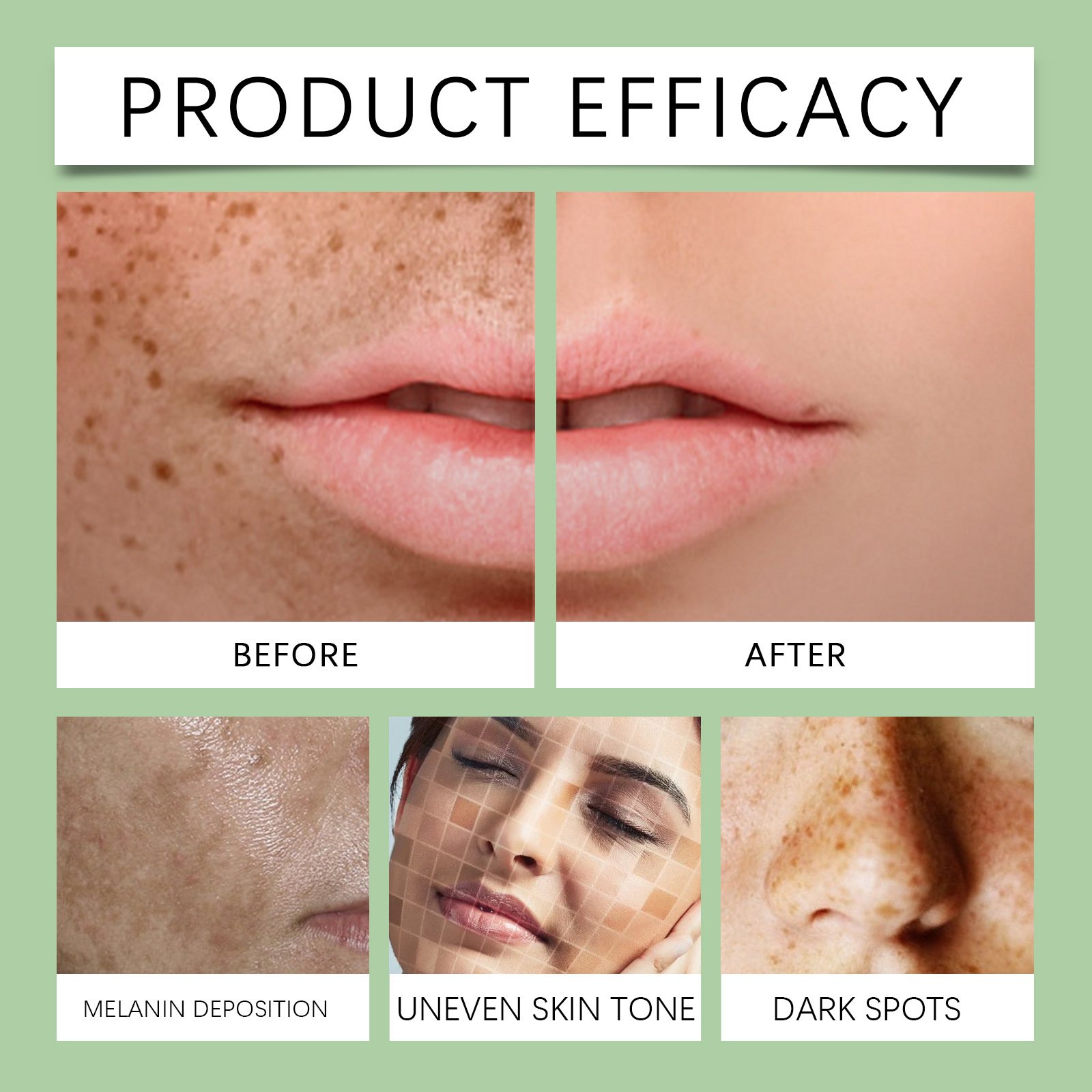 OUHOE Pimples Melasma Blemish Removal Dark Spot Remover Cream Strong Bleaching Whitening Face Freckles Remove Corrector Cream
