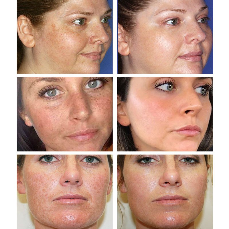Private Label Freckle Removal Face Cream Strong Bleaching Whitening dark spot remover cream