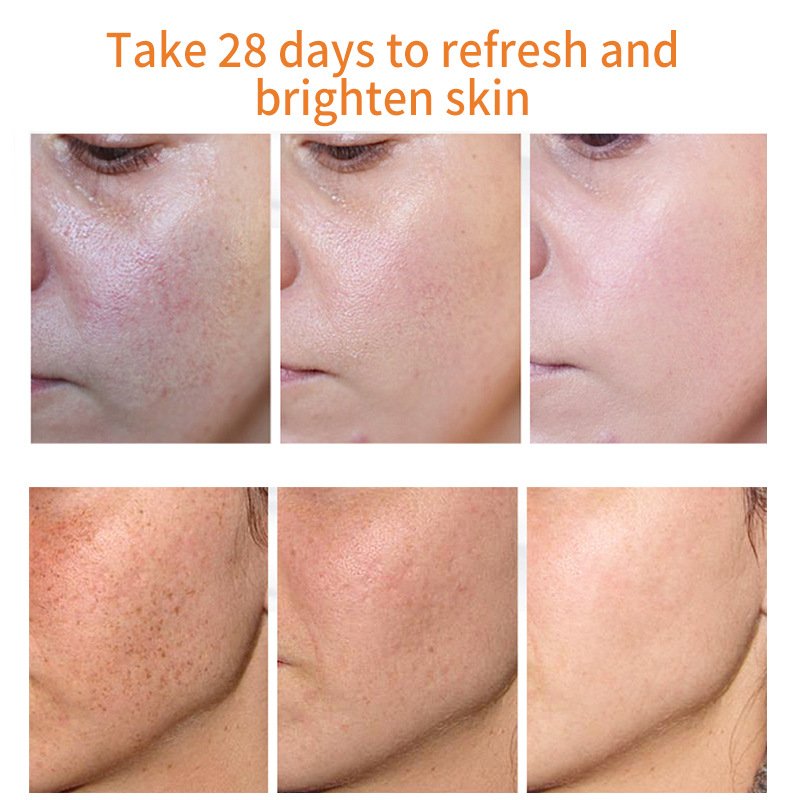 Private Label Freckle Removal Face Cream Strong Bleaching Whitening dark spot remover cream
