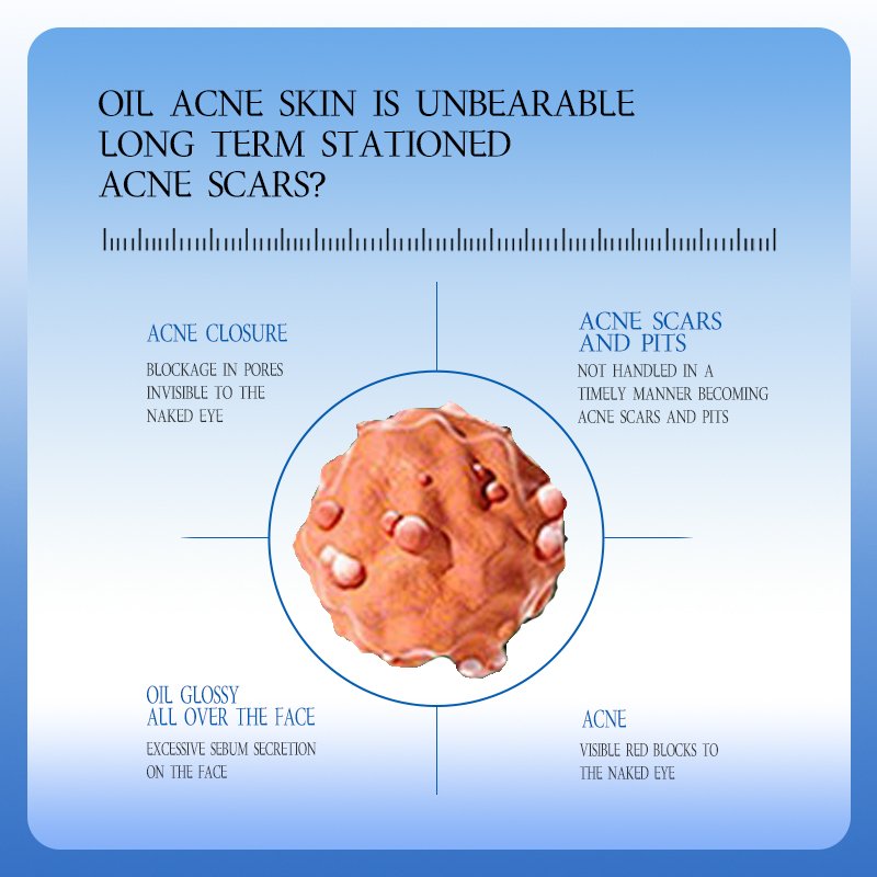 Private Label anti acne face cream moisturizing whitening skin care lightening natural organic facial Cream