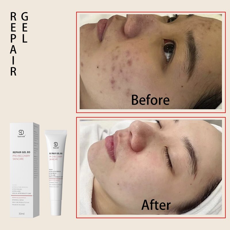 B5 Maximumturmeric face cream for acne treatment Repair PRO-RECOVERYSKINCARE acne scar treatment cream Soothing