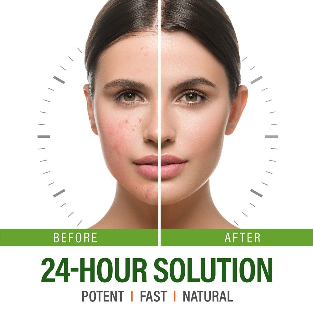 OEM Acne Treatment Cream Anti Acne Face Cream Pimple Removal Spots Oil Control Shrink Pores Moisturizing Skin Care Cream