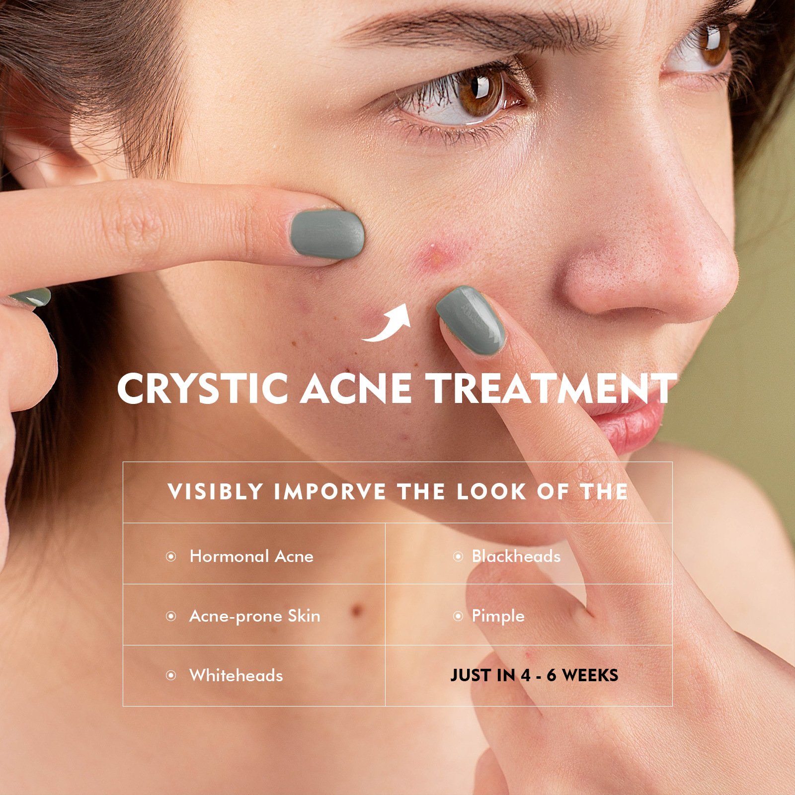 High Quality Fade Acne Mark Shrink Pore Soothing Removal Pimple Skin Care Cream