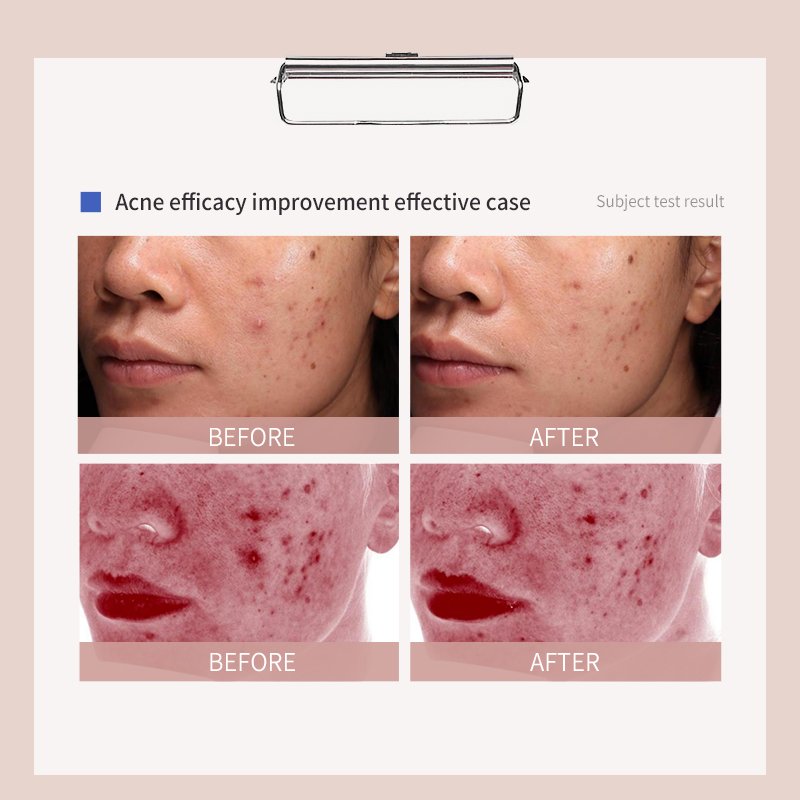 Facial Skin Care Face Cream Whitening And Acne Removal Pimple Face Anti Acne Cream