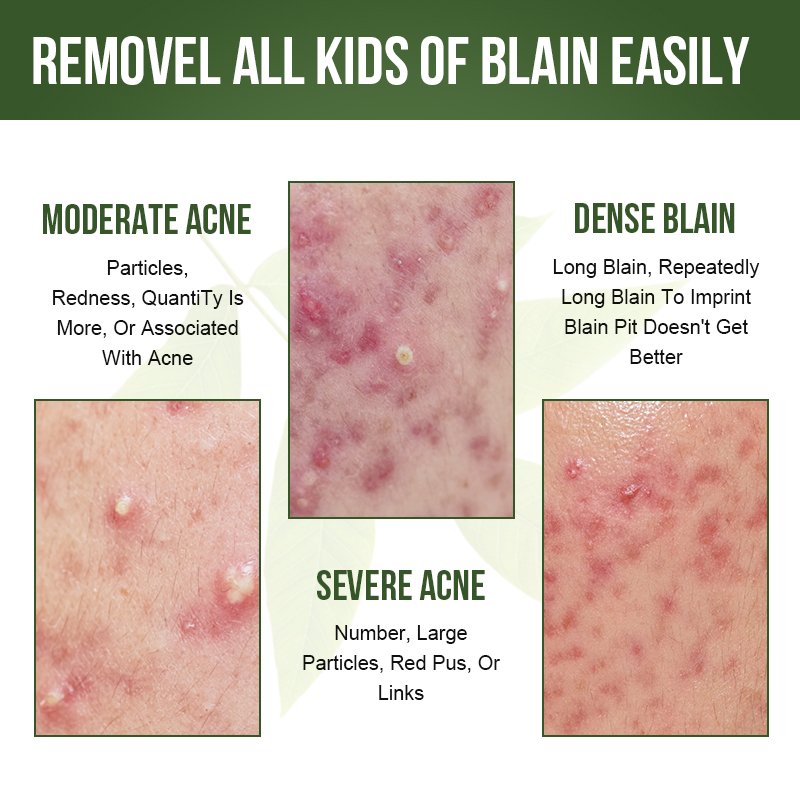 Natural Organic Tea Tree Moisturizing Pimples Dark Spot Remover Cream Skin Care Anti Acne Treatment Face Cream