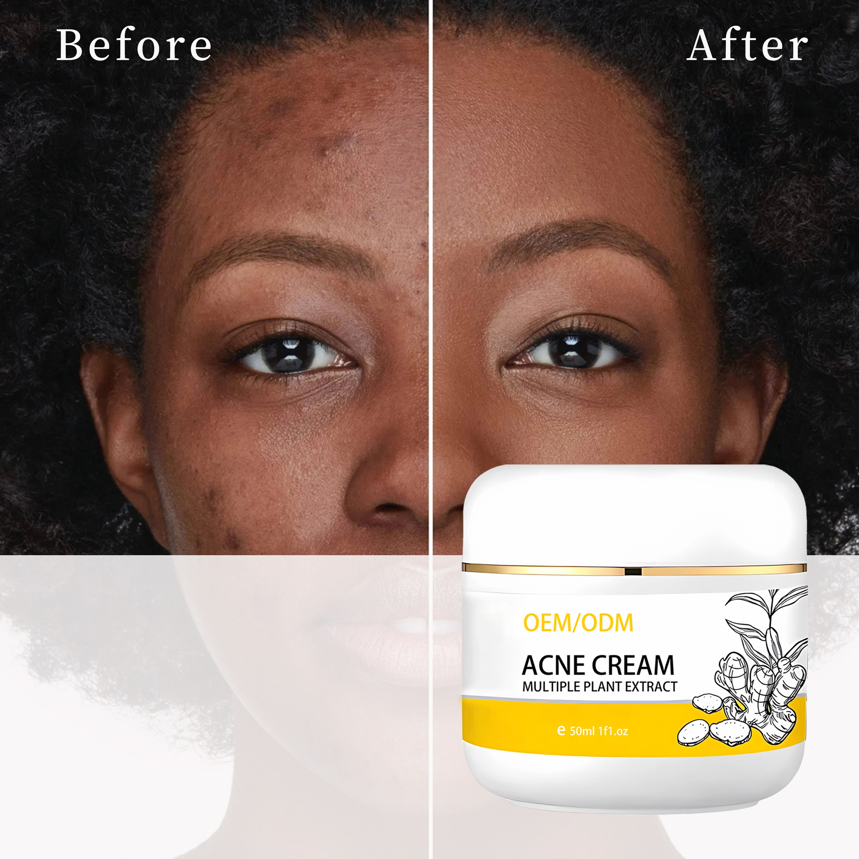 Private label turmeric face cream Facial whitening And Acne Removal Pimple Face Anti Acne Cream best face cream for fair skin