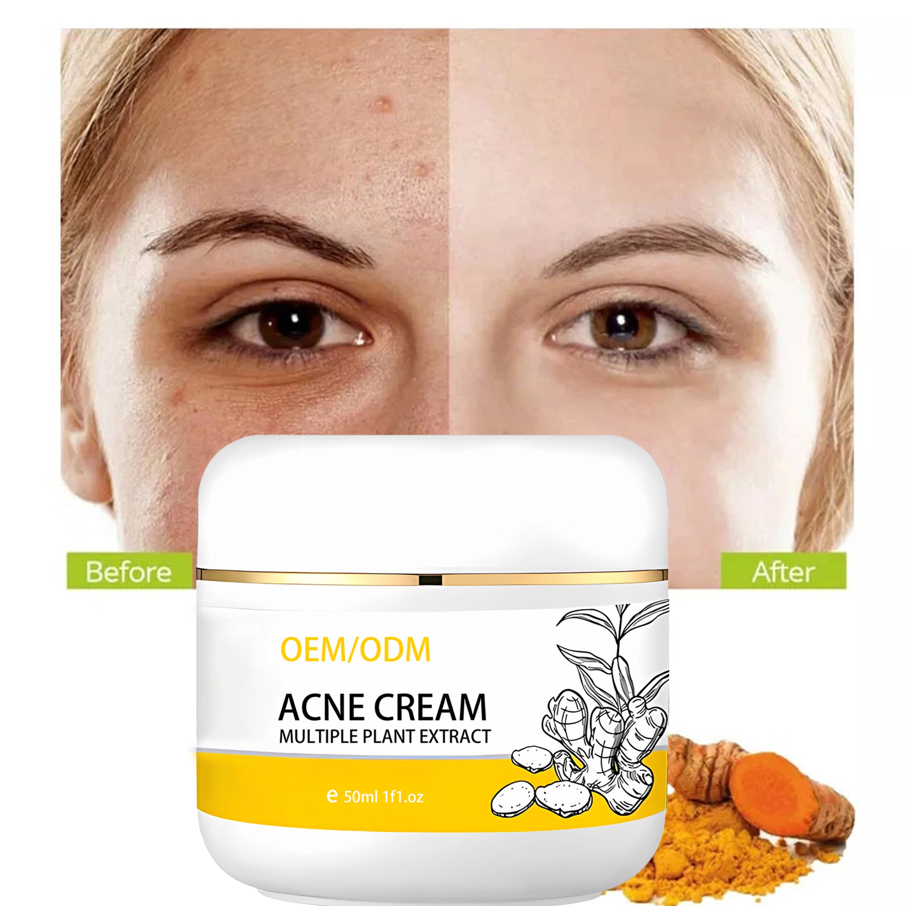 Private label turmeric face cream Facial whitening And Acne Removal Pimple Face Anti Acne Cream best face cream for fair skin