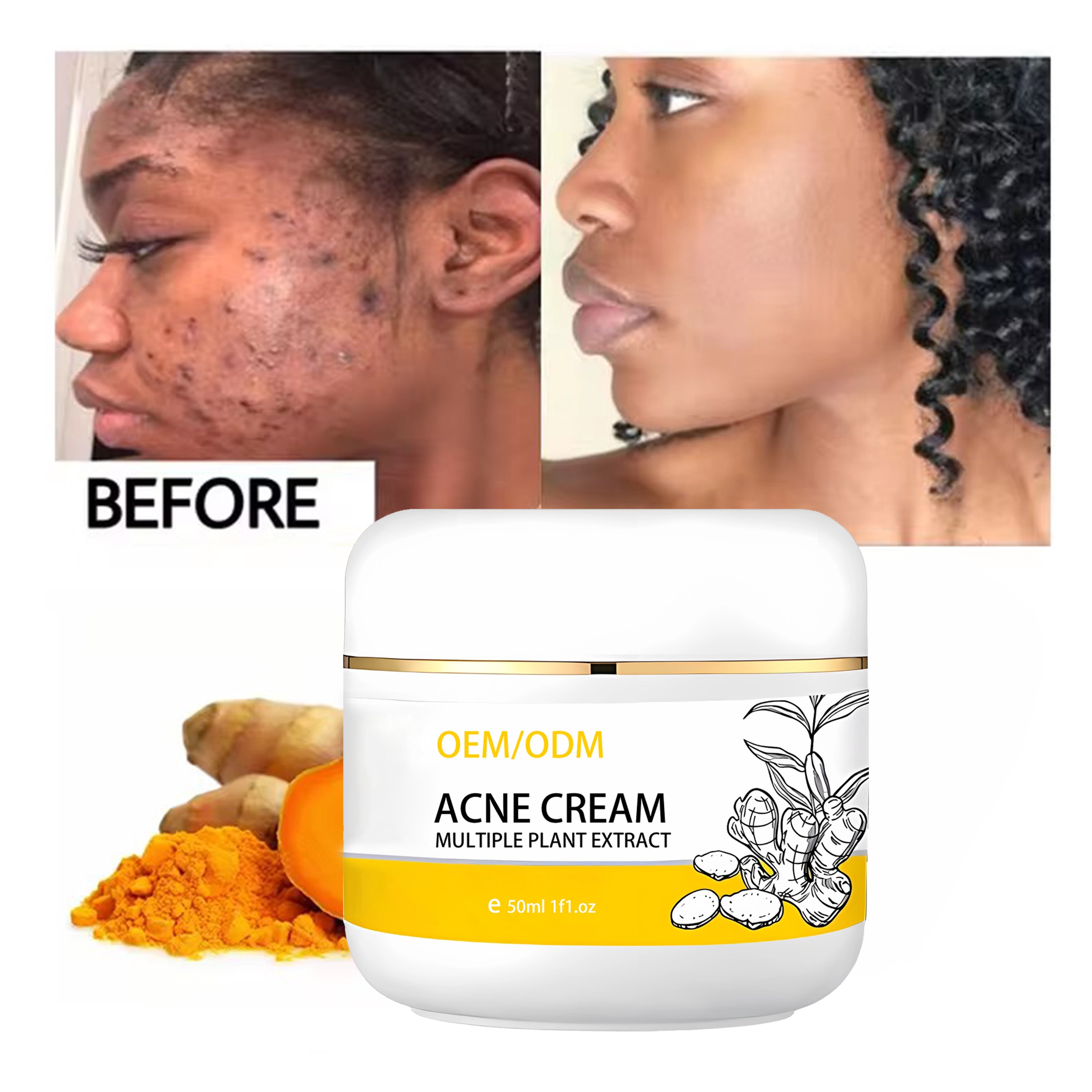 Private label turmeric face cream Facial whitening And Acne Removal Pimple Face Anti Acne Cream best face cream for fair skin