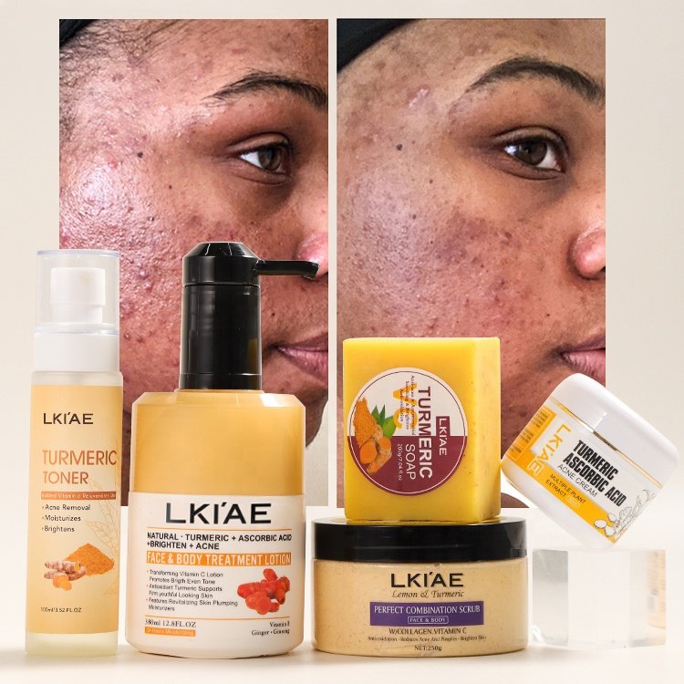 Private Label Toner Body Scrub Lotion Face Cream Soap Bar Caramel Acne Treatment Tumeric Skin Care Set (New) For Skin Lightening