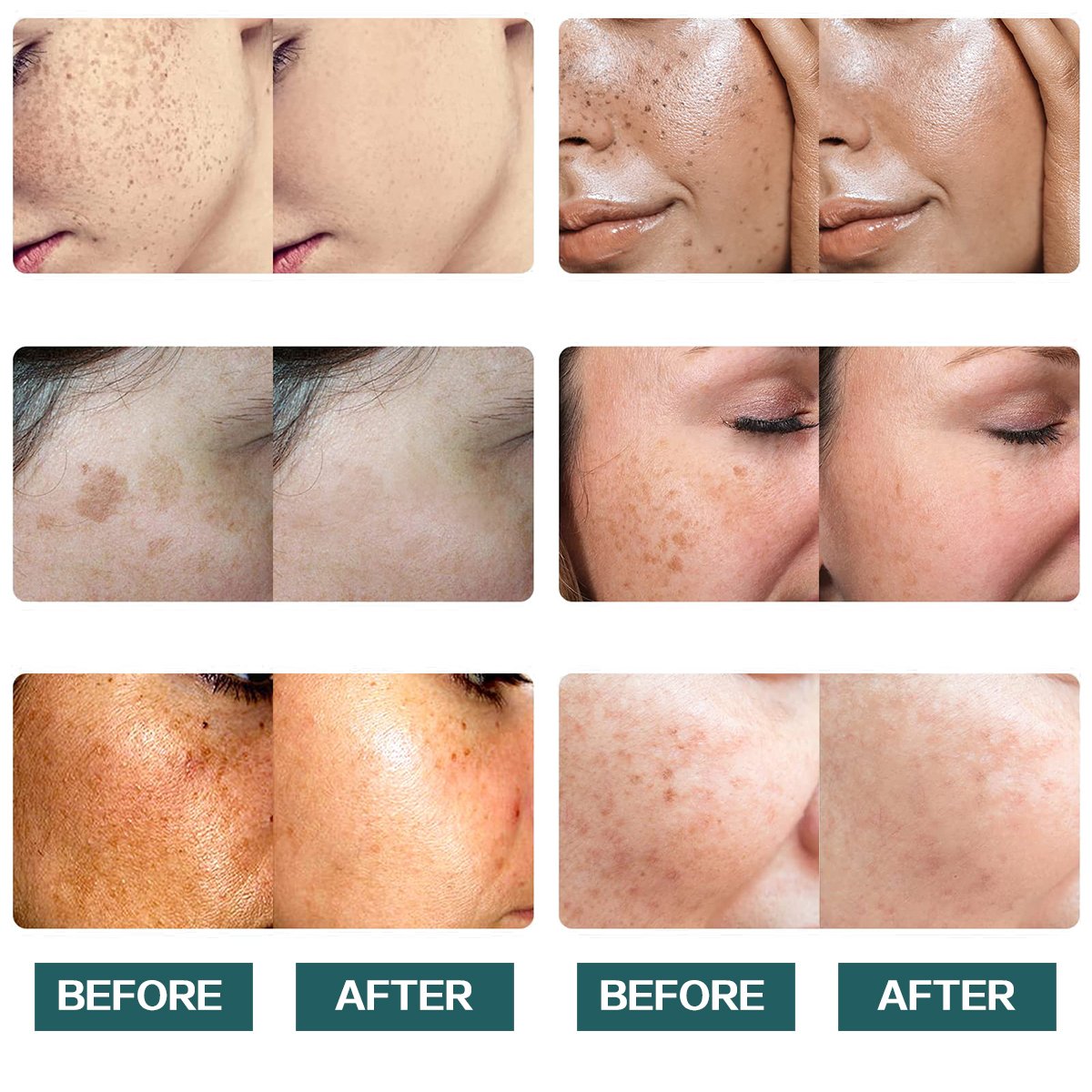 Anti Pigmentation Aging Brightening Lightening Whitening Melasma Removal Dark Spot Remover Corrector Face Cream For Dark Skin