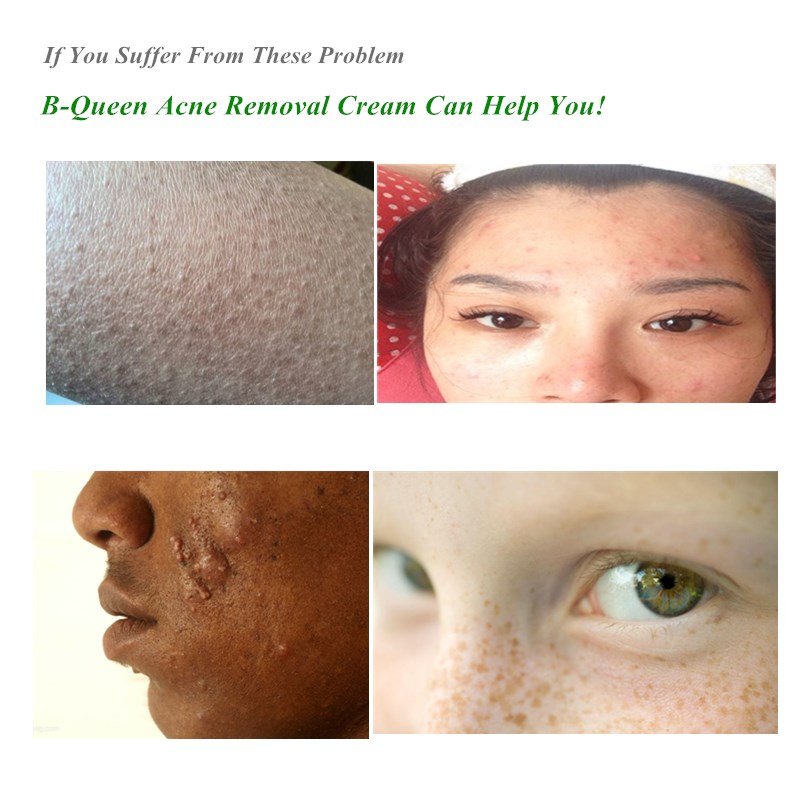 Thai Face Rose Cream for Acne 50g