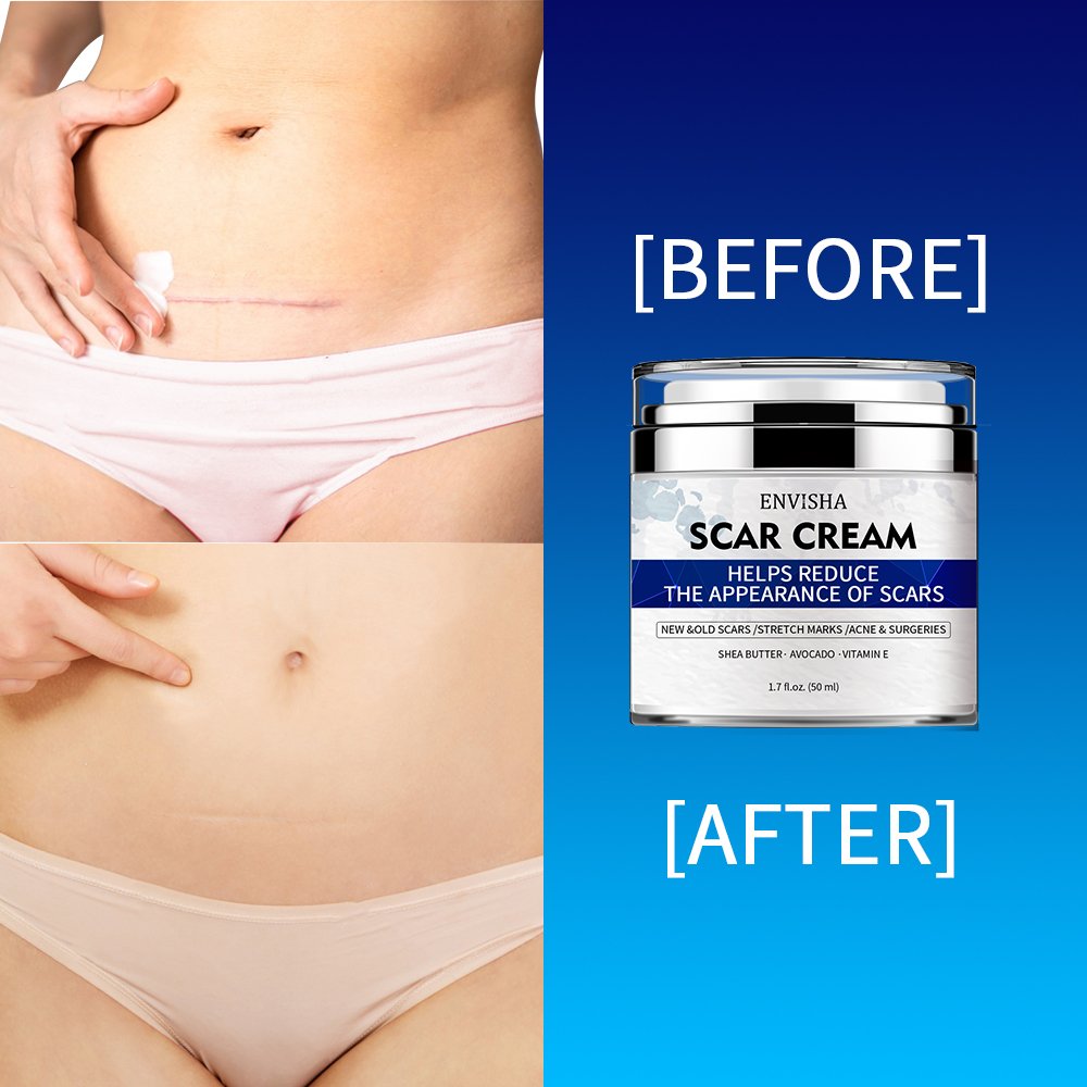 Herbal Tummy Leg Face Silicone Scar Cream Pimples Stretch Marks Remove Cream Strong Effective Acne Scar Removal Cream