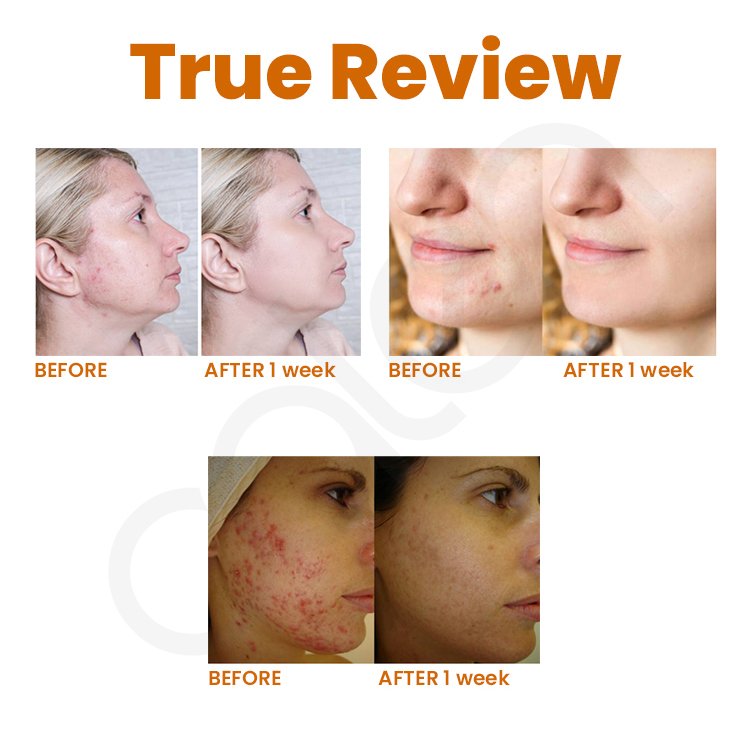 Oalen Wholesale ODM OEM 100% Natural Acne Treatment Whitening Anti-aging Turmeric Face Cream