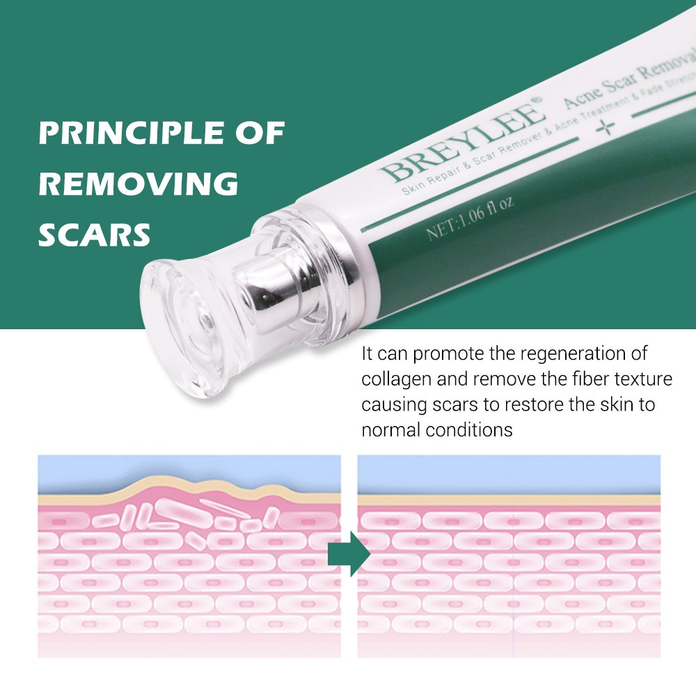 BREYLEE Acne Scar Removal cream Treatment cream