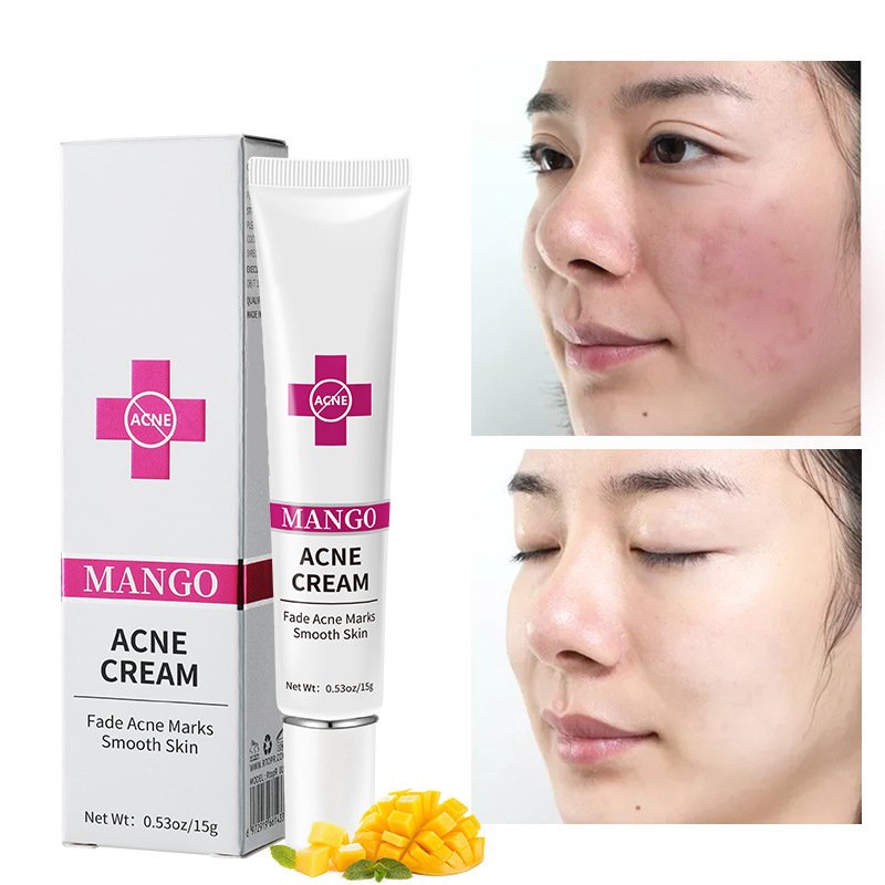 Wholesale 15g Private Label Organic Fade Acne Treatment Marks Smooth Skin Mango Acne Cream