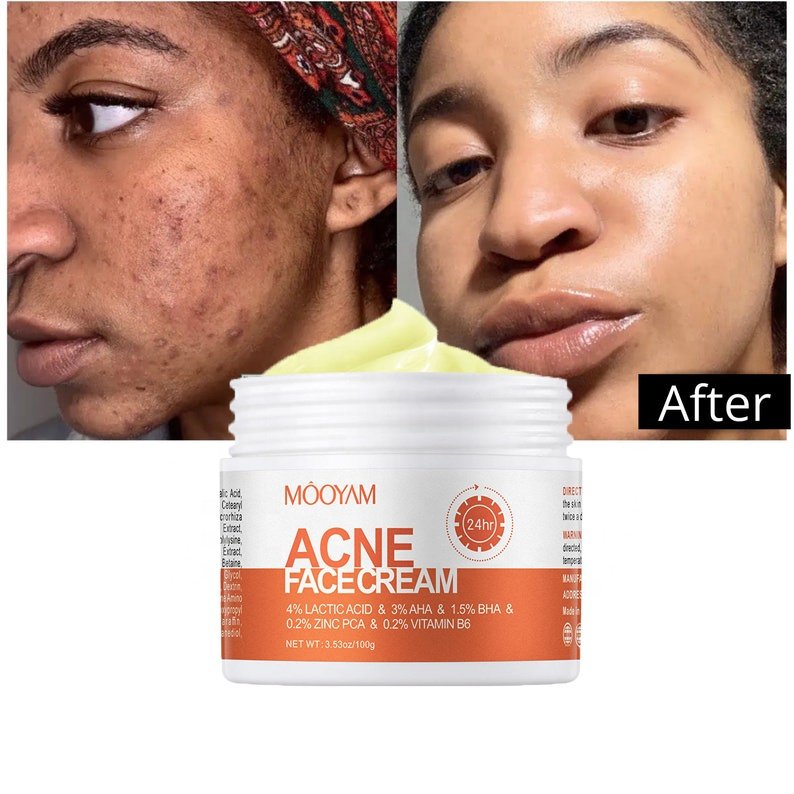 Private Label Organic Skin Care Acne Wrinkle Dark Spot Remover Moisturizer Bleaching Acne Treatment Face Cream