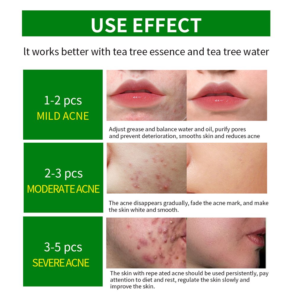 Private Label Vegan Products Skin Care Face Cream Pimple Marks Removal Cream