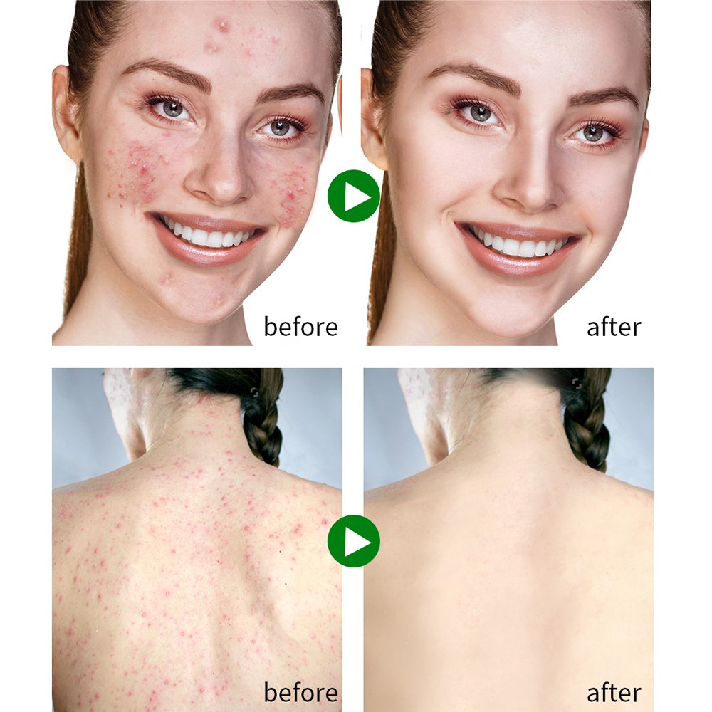 Private Label Vegan Products Skin Care Face Cream Pimple Marks Removal Cream