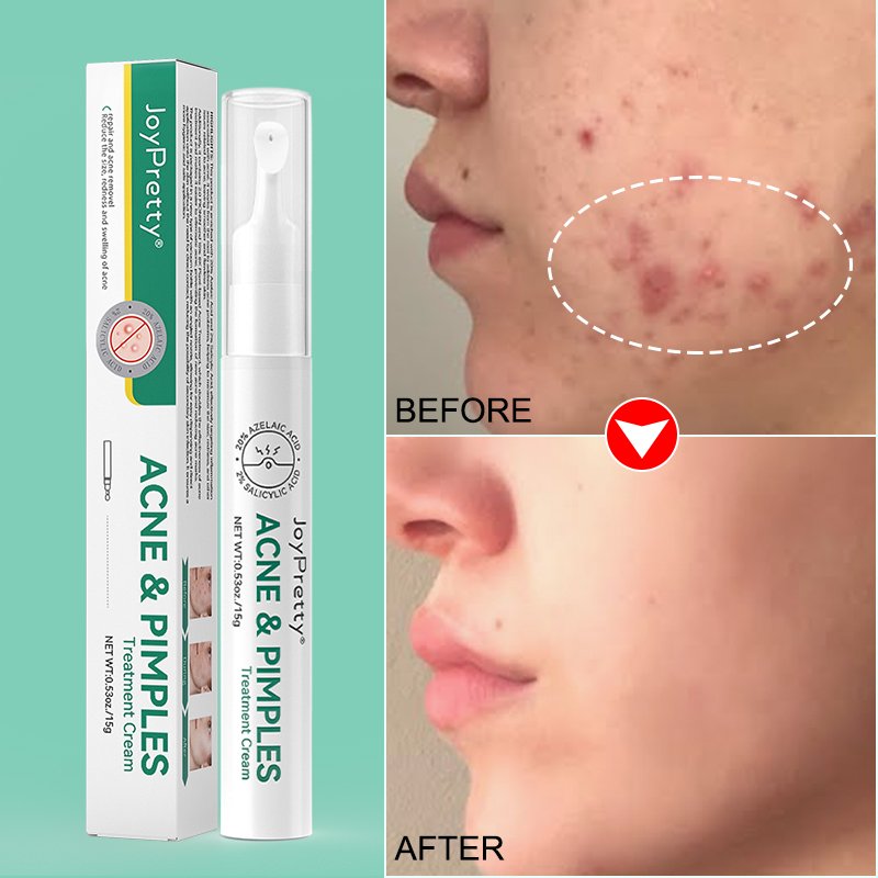 Joypretty Acne Pimples Reduce Blackheads Acne Gel For Face acne cream treatment