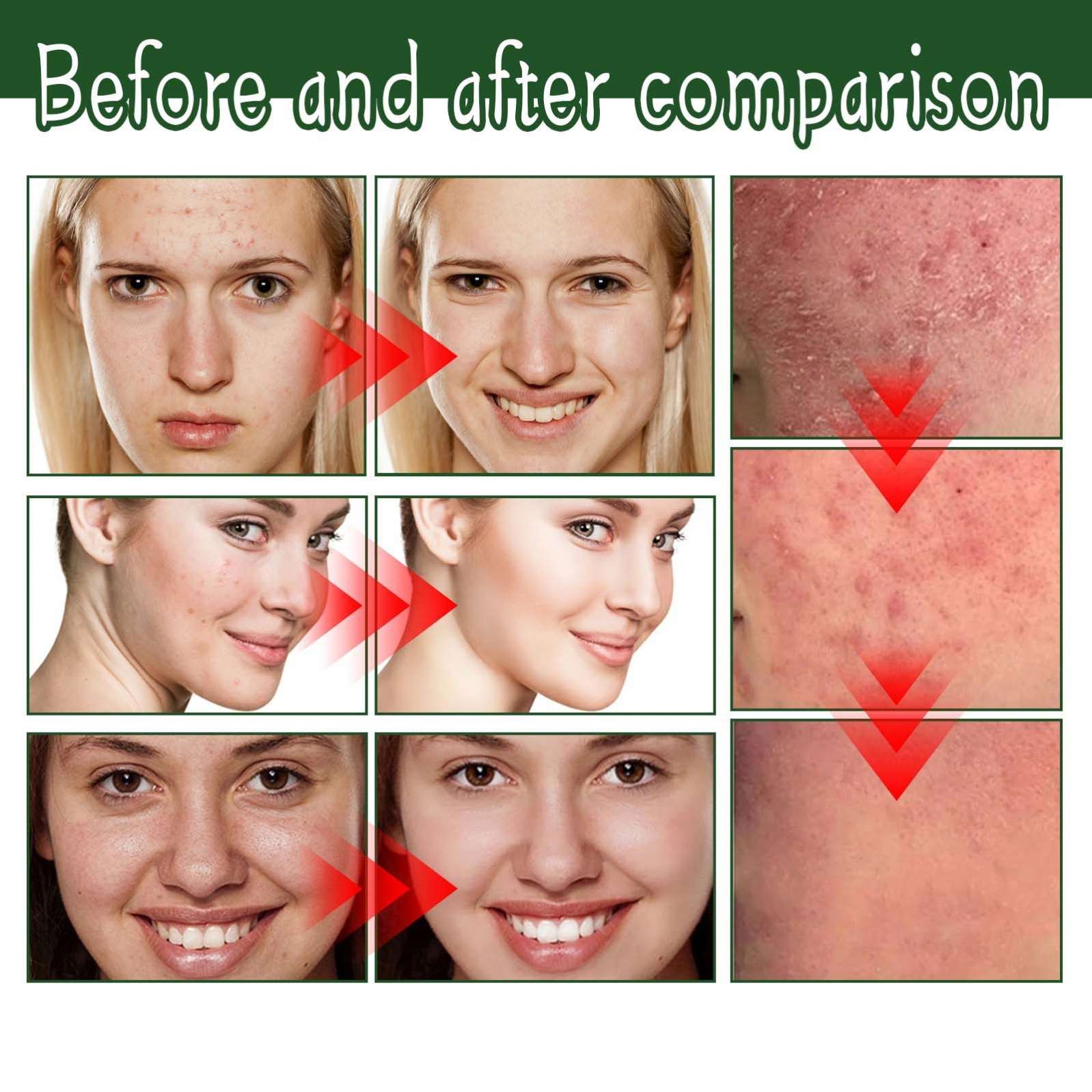 South Moon Collagen Vitamin Moisturizing Anti Aging Acne And Pimple Dark Spot Removal Whitening Corrector Face Cream For Face