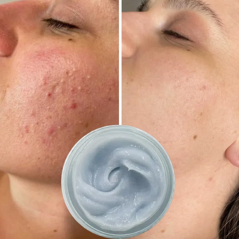 Private Label Blue Acne Lotion Whitening Moisturizer Dispel Acne And Closed Mouth Blue Salicylic Acid Whitening Face Cream OEM
