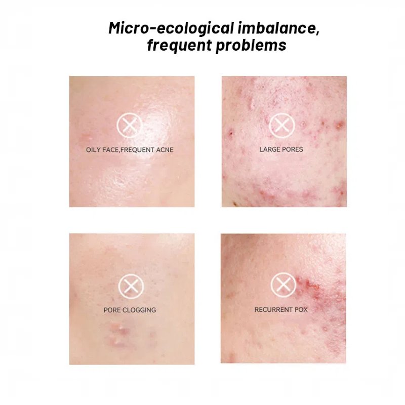 Private Label Blue Acne Lotion Whitening Moisturizer Dispel Acne And Closed Mouth Blue Salicylic Acid Whitening Face Cream OEM