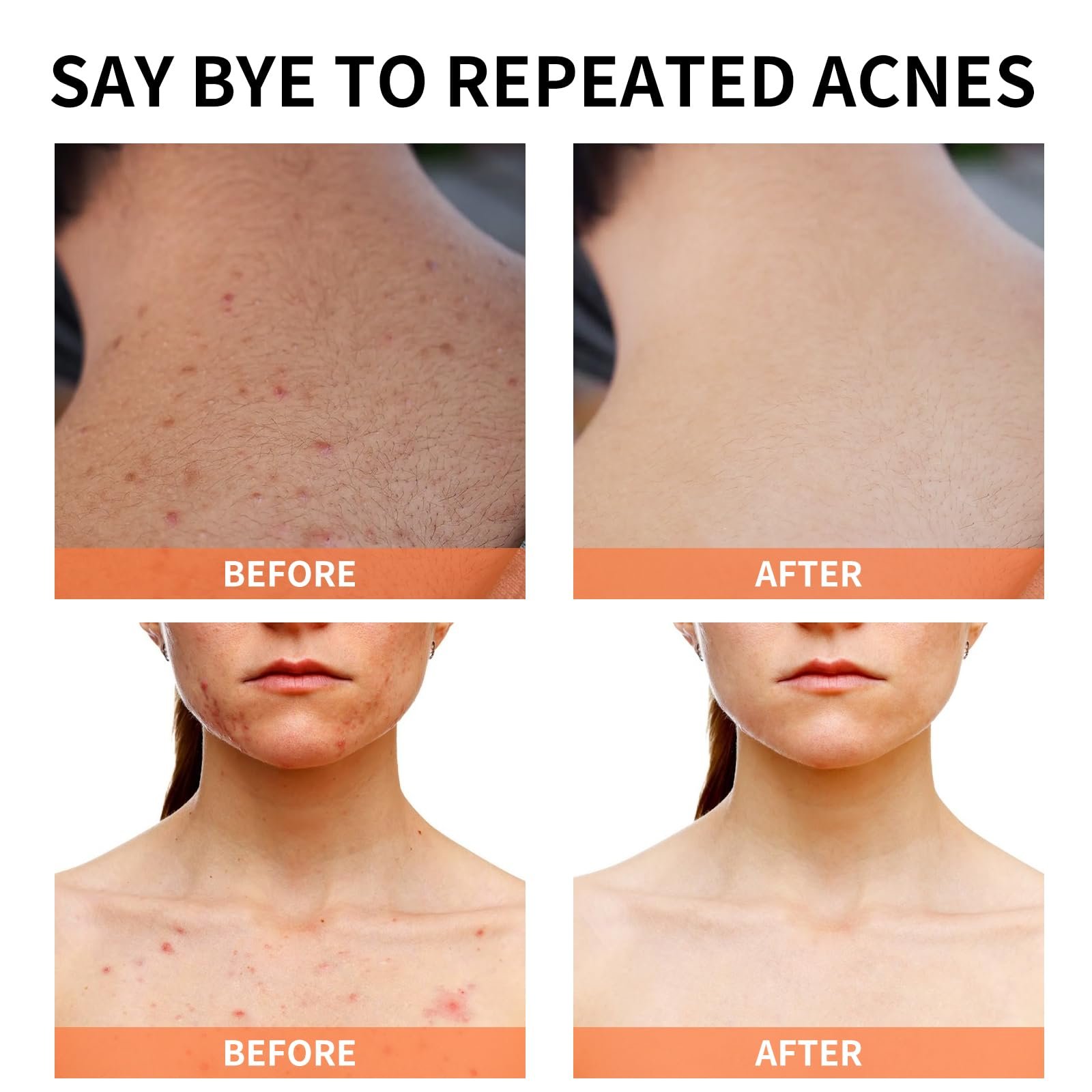 1 Week Fast Control Brightening Treatment Anti Remove Acne Scars Face Cream