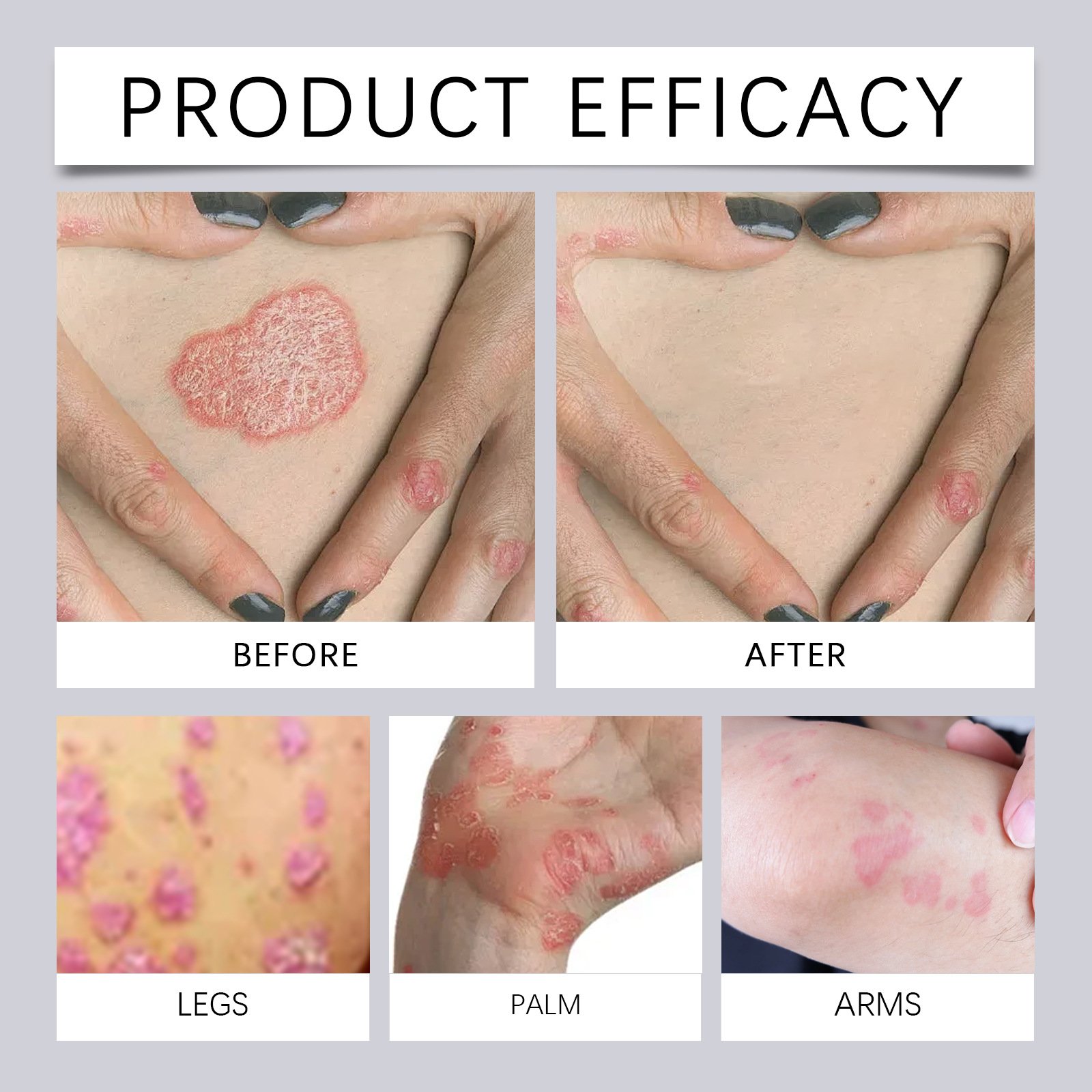 Bee Venom Cream Beauty Skin Care Face Black Freckle Acne Fade Dark Spot Removing Corrector Anti Freckle cream