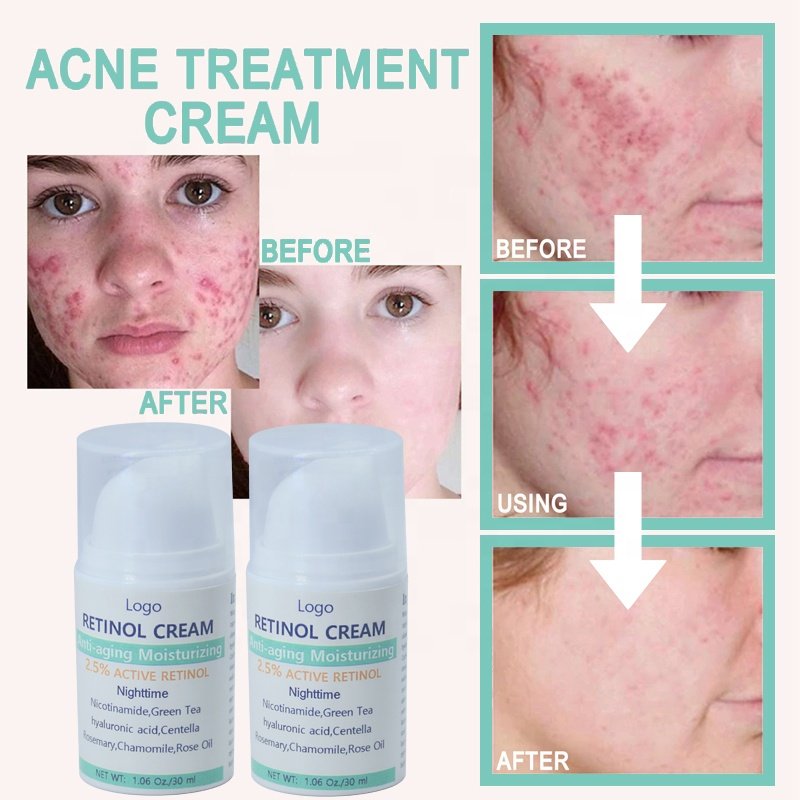 Private Label Pimples Treatment Oil Control Skin Repair Repair Acne Spot Removal Treatment Cream