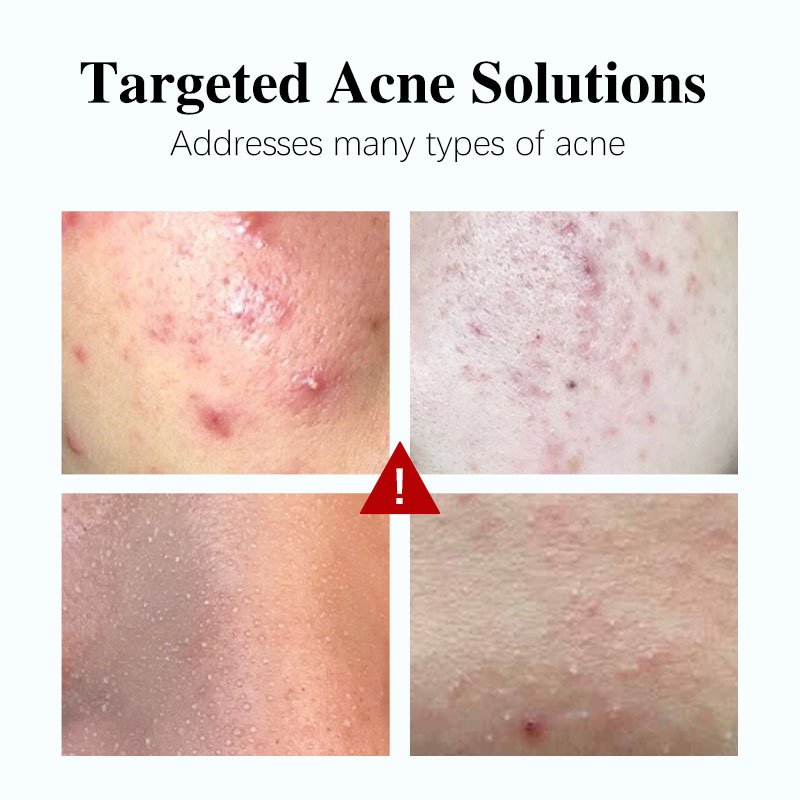 The Best Effective Face Cream Reduce Acne Pimple Salicylic Acid Acne Treartment Face Cream For Home Use