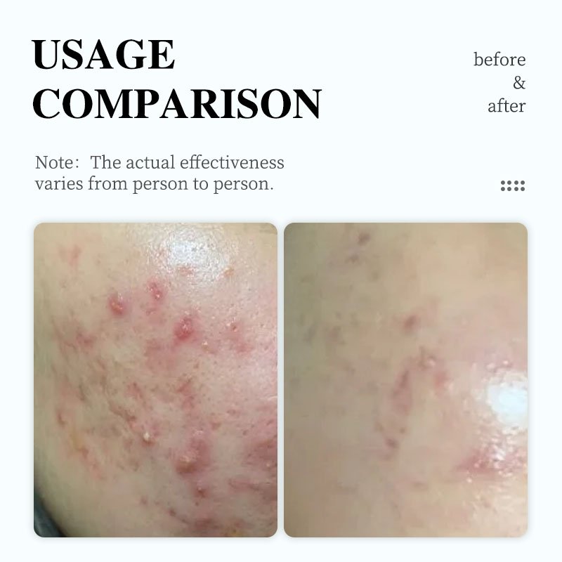 The Best Effective Face Cream Reduce Acne Pimple Salicylic Acid Acne Treartment Face Cream For Home Use