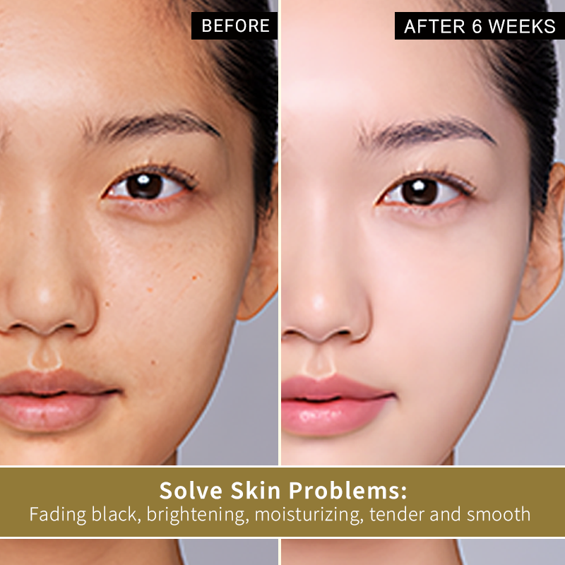 Face Cream pimple remover Niacinamide Centella Shea Butter Vitamin E Salicylic Acid cream for pimples